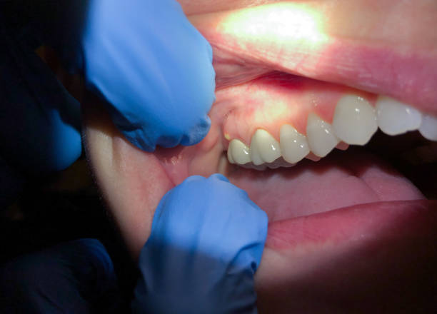 Best Emergency Dental Care for Broken or Chipped Teeth in Bardstown, KY